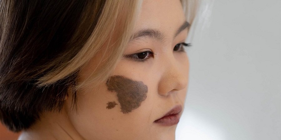 Birthmarks Removal in Riyadh & Saudi Arabia Cost & Price