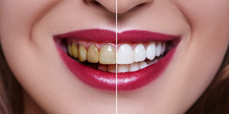 Teeth Whitening in Riyadh & Saudi Arabia Aesthetic Clinic