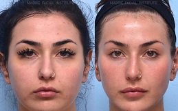 Best Dermal Fillers Cost in Riyadh