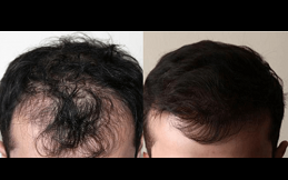 Best Hair Loss Treatment Clinic in Riyadh