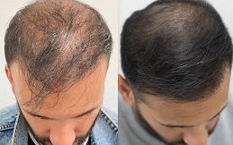 Best Hair Loss Treatment in Riyadh