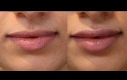 Best Lip Filler injection Clinic in Riyadh