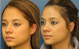 Best Rhinoplasty Clinic in Riyadh