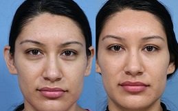 Dermal Fillers cost in riyadh