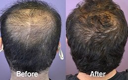 Hair Loss Treatment in Riyadh