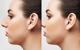 Rhinoplasty in Riyadh