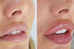 Best Russian Lip Fillers in riyadh