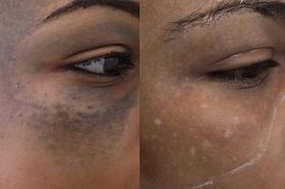 Best Birthmarks Removal cost in Riyadh