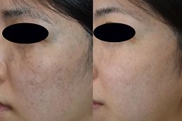 Best Birthmarks Removal in riyadh