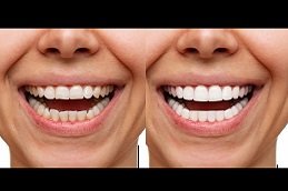 Best Teeth Whitening Clinic in Riyadh