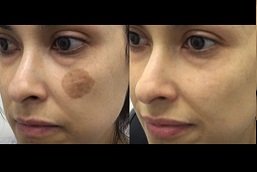 Birthmarks Removal Clinic Riyadh