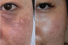 Birthmarks Removal in riyadh