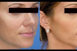 Laser Treatment cost in riyadh