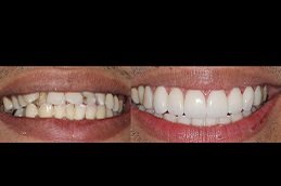 Best Composite Veneers Clinic in Riyadh