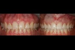 Best Composite Veneers cost in Riyadh