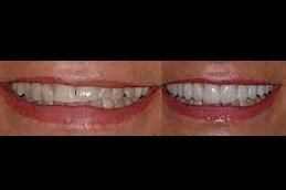 Best Composite Veneers in Riyadh