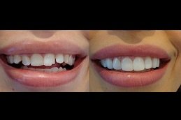 Composite Veneers Clinic Riyadh