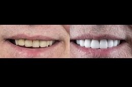 Composite Veneers cost in riyadh