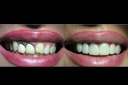 Composite Veneers in Riyadh