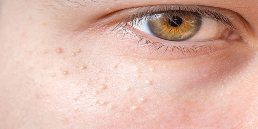 Syringoma Laser Treatment Cost in Riyadh