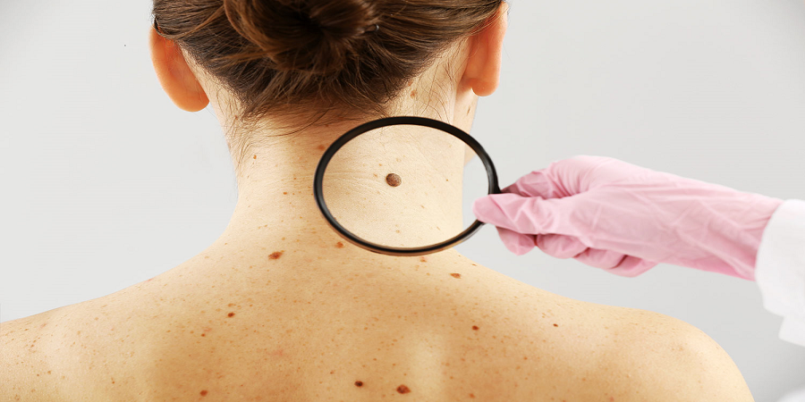 Birthmark Removal Cost in Riyadh and Saudi Arabia