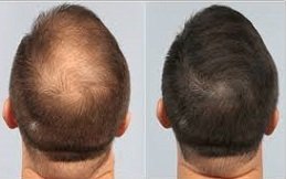 Hair Loss Treatment in Riyadh & Saudi Arabia