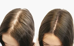 Hair Loss Treatment in Riyadh & Saudi Arabia