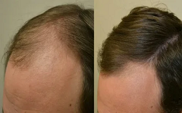 Hair Loss Treatment in Riyadh & Saudi Arabia