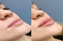 Russian Lip Fillers in Riyadh and Saudi Arabia