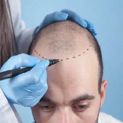 تكلفة زراعة الشعر في الرياض