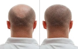hair transplant cost in riyadh