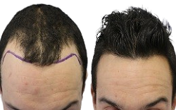 تكلفة زراعة الشعر في الرياض