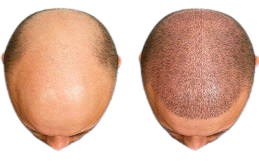hair transplant cost 