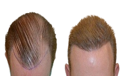 تكلفة زراعة الشعر في الرياض