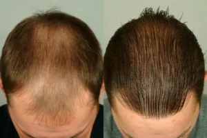 hair transplant 