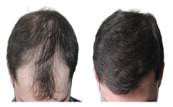 تكلفة زراعة الشعر في الرياض