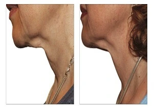 فينوس ليجاسي في الرياض