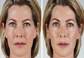 حقن الشفاه في الرياض