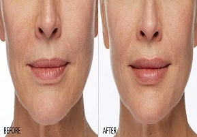 حقن الشفاه في الرياض