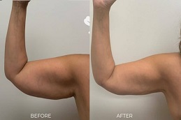 أفضل بلازما جيه لجراحة الفخذين والذراعين في الرياض