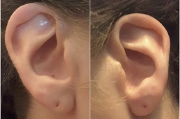 أفضل جراحات ثقب الأذن في الرياض