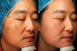 أفضل جراحة إنلايتن بيكو جينيسيس في الرياض