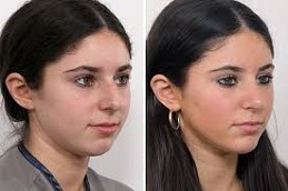 أفضل جراحة الأنف بالسيليكون في الرياض