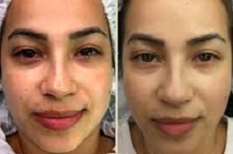 أفضل جراحة التقشير الأخضر في الرياض