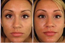 أفضل جراحة الفراكشنال ليزر مع البلازما الغنية بالصفائح الدموية في الرياض