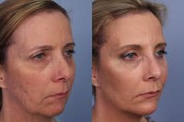 أفضل جراحة الفراكشنال ليزر مع البلازما الغنية بالصفائح الدموية في الرياض