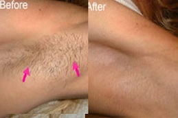 أفضل جراحة بوتوكس الإبط في الرياض