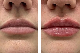 أفضل جراحة بوتوكس لتكبير الشفاه في الرياض