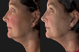 أفضل جراحة بيلكيرا في الرياض