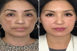 أفضل جراحة تبييض دائم للبشرة في الرياض